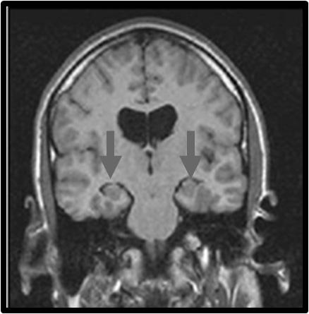 Ⅱ. 국내외현황 9 ( 뇌영상진단지표 ) 뇌영상진단지표는비침습적진단방법이며, 치매의전단계를진단하는지표로중요성이부각 15) - MRI (Magnetic Resonance