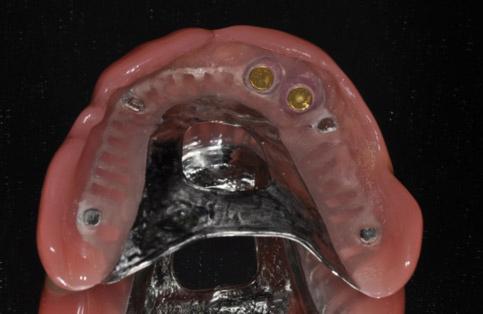 Fig. 8. Final dentures with magnet assemblies.