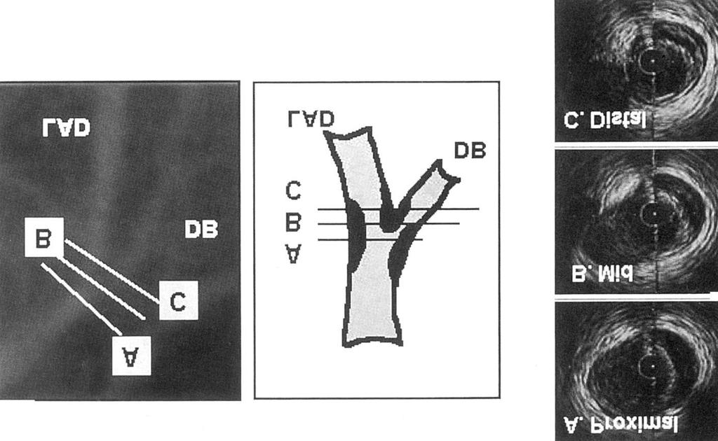 Fig. 1. Composite illustration demonstrating IVUS analysis for bifurcation lesion of LAD.