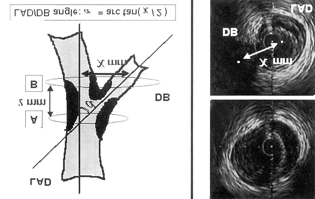 A Fig. 3. Illustration demonstrating IVUS analysis for LAD/DB angle. The LAD/DB angle was calculated as a function of LAD/DB angle arc tan /2.