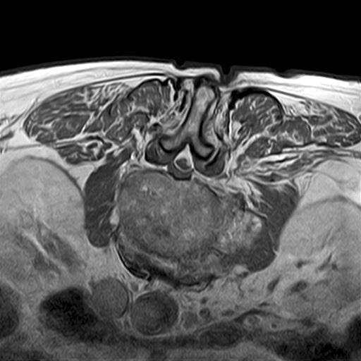 MRI상제 2 요추및제3 요추부위에서경막후방에존재하는농양에의한경막낭의압박이관찰되었고제4 요추부위의척추관전방에서도같은양상의병변이관찰되었다 (Fig. 1).