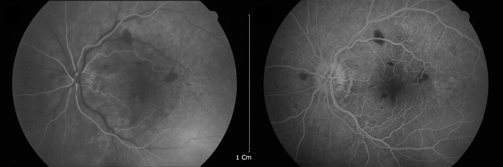 - 손영우 외 : 안부대상포진에서의 다양한 안병증 1예 - Figure 4. Fluorescein angiography of the left eye at the initial visit. () t 29 seconds after injection, filling of arterioles are still incomplete.