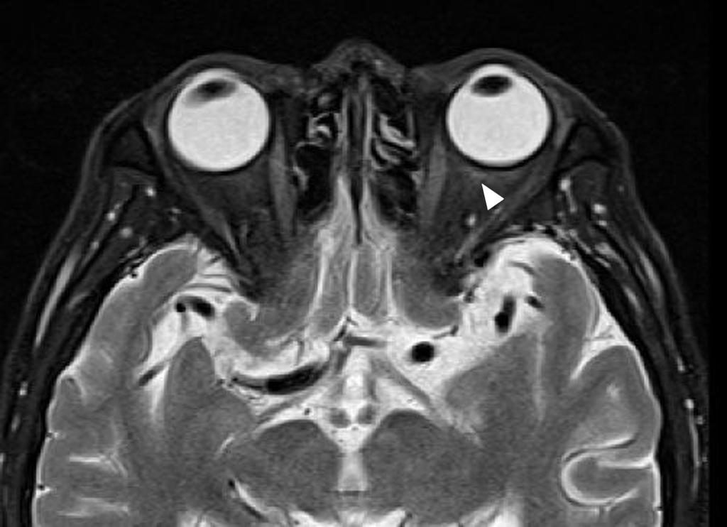 6개월 후 좌안의 안저검사에 서 망막동맥의 협소화 및 시신경 유두창백을 볼 수 있었고, 시력은 호전되지 않았다(Fig. 3).