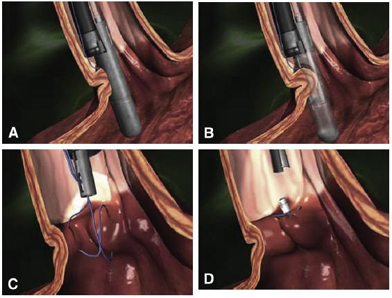 2016 대한간학회추계 Single Topic Symposium Figure 2. Transoral gastroplasty (TOGA) sleeve stapler. A, The gastroscope is positioned in retroflexion to visualize the stapler at the gastroesophageal junction.