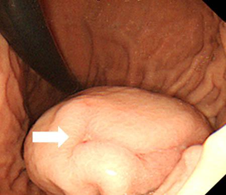 Figure. Endoscopic findings. (A) There are two soft cystic submucosal tumors with bloody materials at greater curvature of high body and fundus.