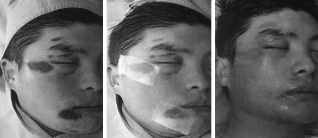 A 26-year-old man with deep abrasion and traumatic tattoos on his face. Preoperative view (A). Intraoperative view. Kaloderm applied on wound (B). Postoperative view at 5 days.