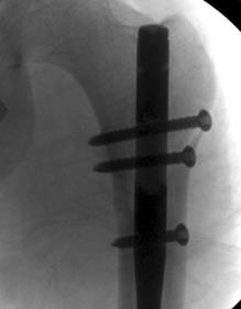 키 175 cm, 몸무게 67 kg 으로단순방사선검사에서우측대퇴골간부에 AO 분류 B1 의골절이관찰되었다 (Fig. 2A). 수상후 2 일째우측대퇴골간부골절에대해직경 9 mm, 길이 380 mm 의 UFN 을사용하여골수강내금속정고정술을시행하였다.