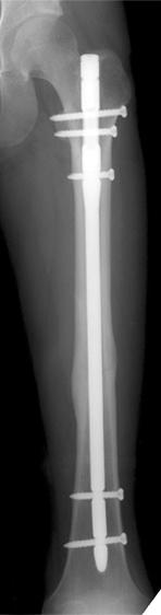 수술직후촬영한우측대퇴골전후면사진에서대퇴골근위부의외측피질골에골절선이발견되었고, 3 차원컴퓨터단층촬영영상에서도대퇴골근위부의골절을확인할수있었다 (Fig. 2B, C, D).
