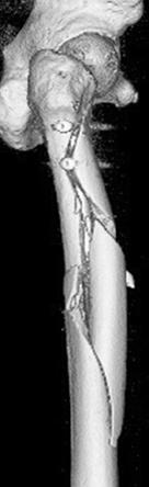 대퇴골 간부 골절의 금속정 삽입 도중 발생한 대퇴골 근위부의 방출형