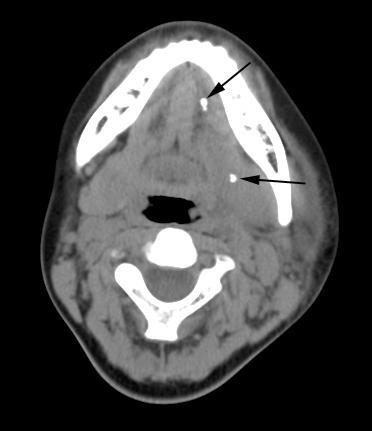 Fig. 3. Bilateral parotid sialadenitis in a 3 year-old boy.