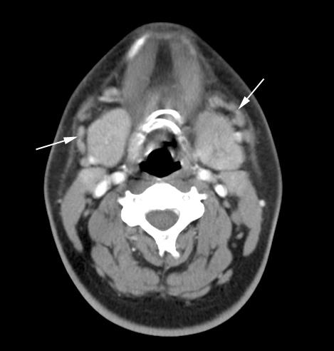 It also shows no abscess associated. Fig. 5. Bilateral submandibular sialadenitis in a 17 year-old boy.