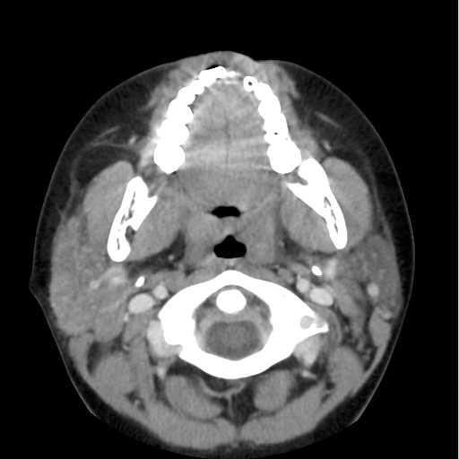 Fig. 6. Sialadenitis in the right parotid and bilateral submandibular glands in a 9 year-old boy. A.