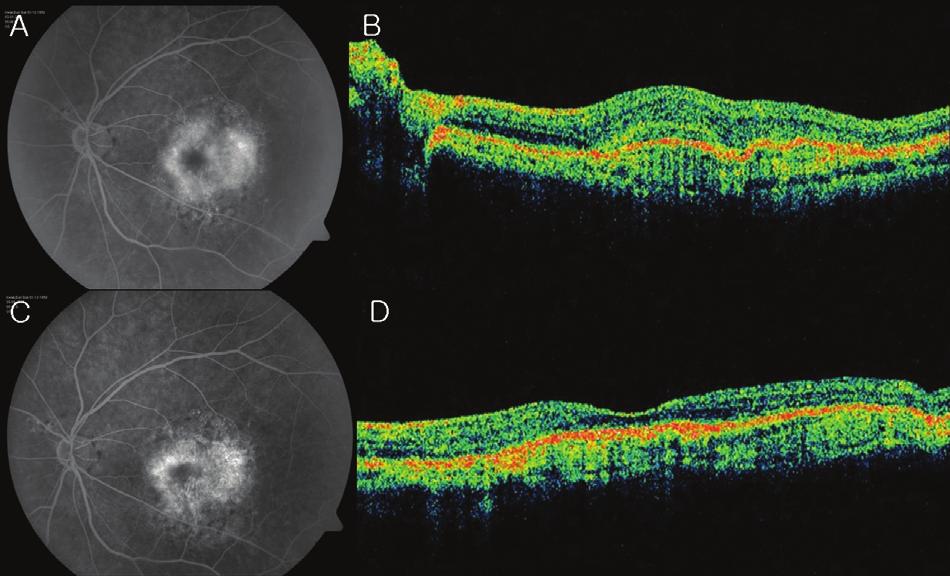대한안과학회지제 50 권제 2 호 2009 년 Figure 5. Changes in best corrected visual acuity and macular thickness on OCT for 3 months after injection of bevacizumab according to the dose. 시력도두군사이에차이가없었으며, 1개월째 2.
