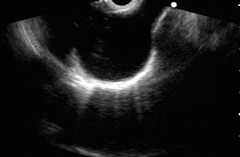 대동맥폐창 (aortopulmonary window, APW) 은대동맥궁하방부위이므로, 우선대동맥궁을먼저찾는다. 이후시계방향으로 90 o 돌리고 up을하여약간밀면두개의원형혈관단면이보인다.