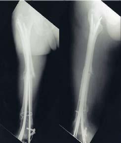 2. A 41-year-old male had undertaken IM nailing for open fracture of femoral midshaft after driver's traffic accident,