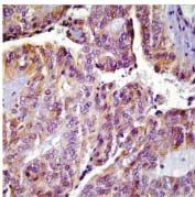 4. Tumor cells show immunoreactivity for GFP (),