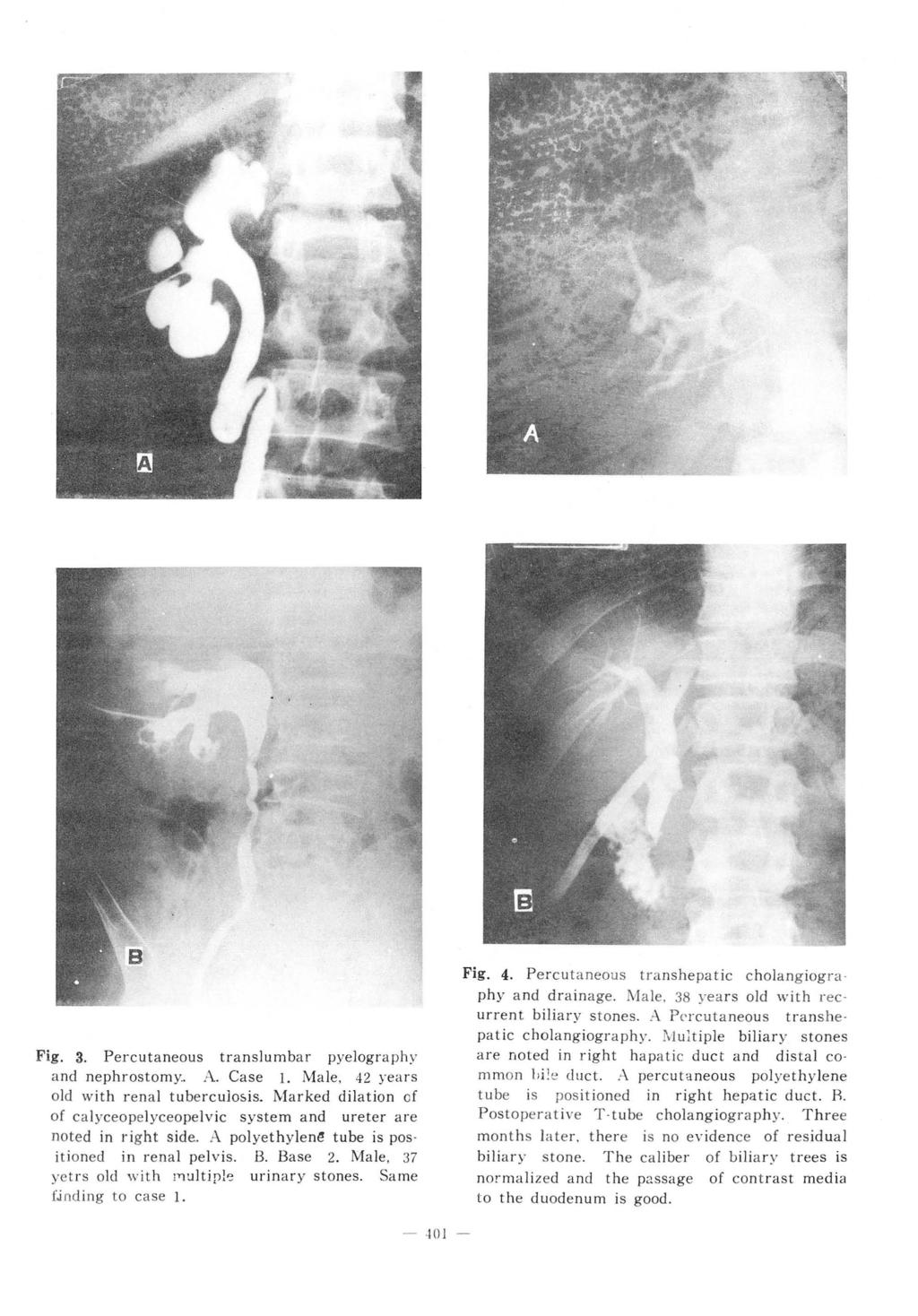 Fig. 3. Percutaneous translumbar pyelography and nephrostomy.. A. Case 1. Male. 42 yea rs old with renal tubercuìosis.