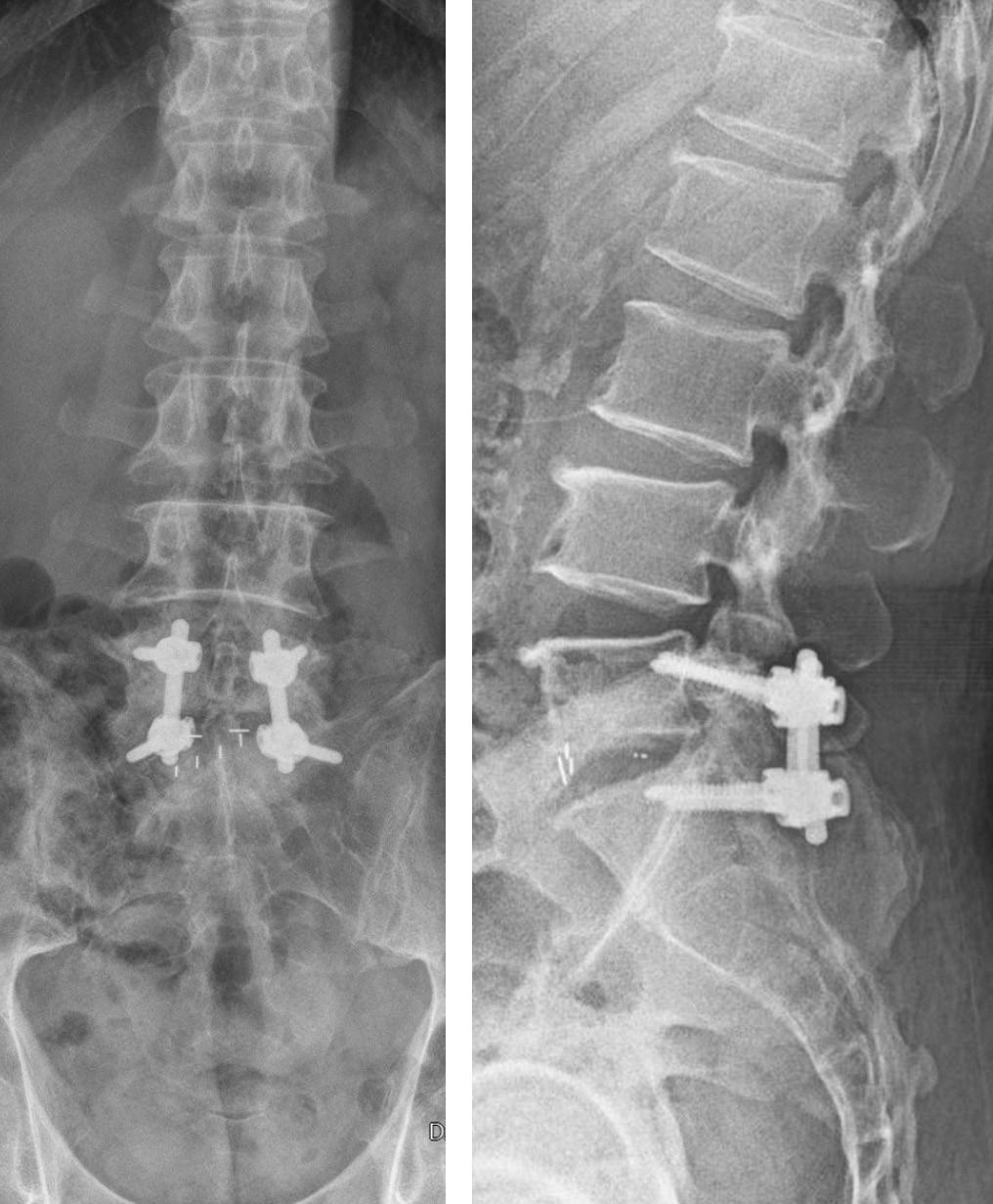 Journal of Korean Society of Spine Surgery Osteoporotic Spine Reconstruction in the Elderly 면서대혈관손상을일으킬위험이있는문제가있고또, 전방피질골을통과했음에도충분한고정력을얻는데실패하였을경우고정된나사못에가해지는부하에의한회전중심 (center of rotation)