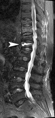 166 Anesth Pain Med Vol. 9, No. 3, 2014 Fig. 1. Lumbar MRI. (A) Acute benign compression fracture, T9, T12, L4, Subacute benign compression fracture, T11, L1, L2, L3, L5 in first MRI.
