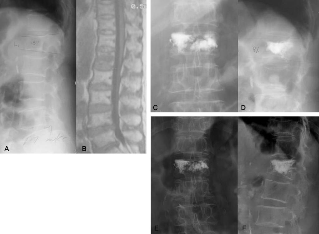 Journal of Korean Society of Spine Surgery Lower-pressure Percutaneous Vertebroplasty Fig. 3. C-PCP. (A,B) L1 compression fracture was happened in 65-year old female patient.