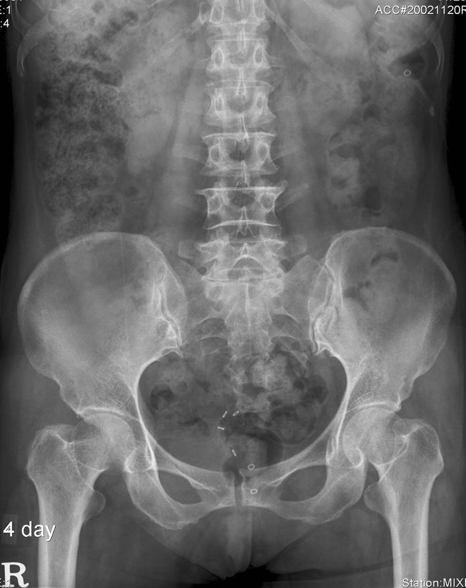 1. 75-year-old woman with rectal intussusception and mild degree of perineal descent syndrome on defecography, and normal transit time on colonic transit time (CTT).
