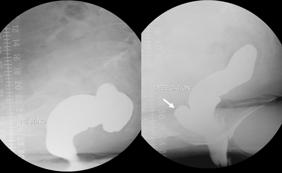 . On defecography, mild degree of downward displacement of anorectal junction and rectal intussusception (arrows) are visualized.