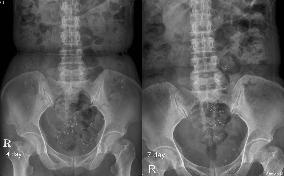 68-year-old woman with pelvic outlet obstruction on CTT and spastic pelvic floor syndrome on defecography.