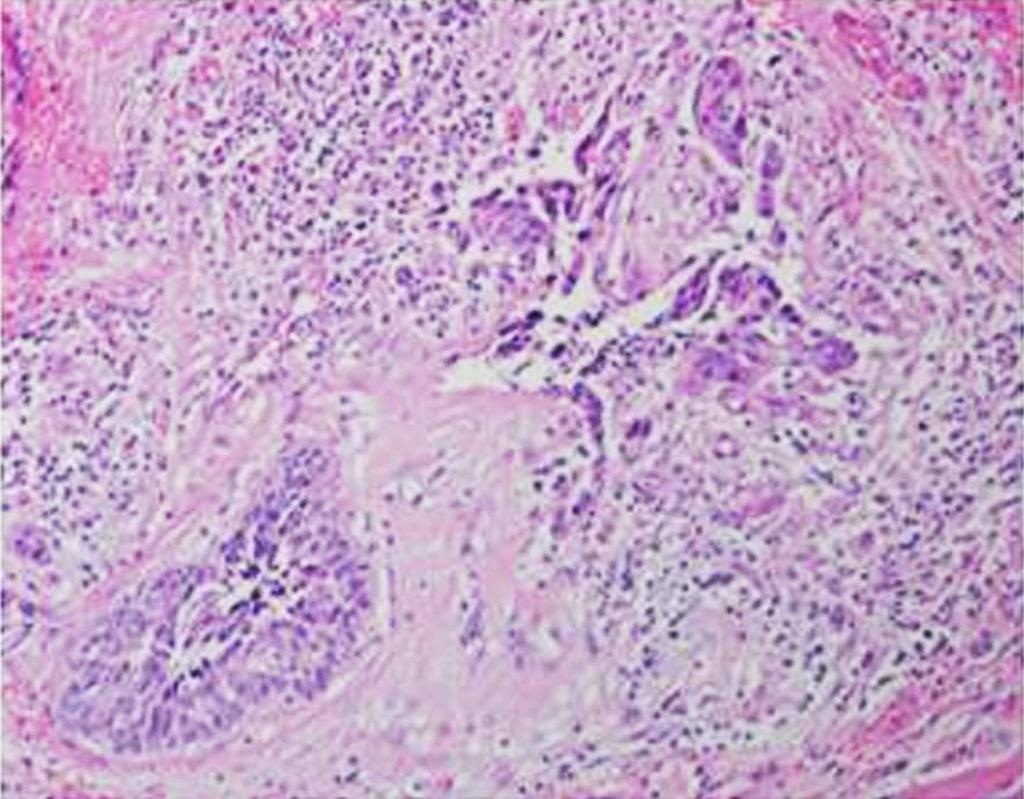(B) Basosquamous carcinoma has an aggressive-growth infiltrative pattern with tongues of tumor cells embedded in dense stroma containing proplastic fibroblasts (arrow).