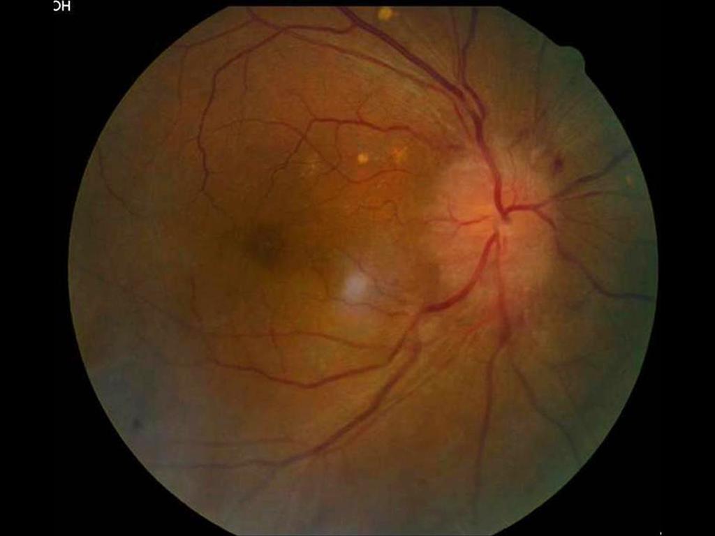 - 대한안과학회지 2012 년제 53 권제 7 호 - A B Figure 1. (A) Fundus photography of 66-year-old male patient (Case 4) with idiopathic optic perineuritis shows grade Ⅳ optic disc edema in his right eye.