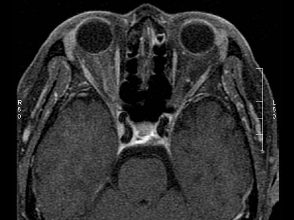 - 강혜민 김혜영 : 한국인 특발성 시신경주위염의 임상 양상 - A B Figure 2. M agnetic resonance imaging scan of the orbit with contrast infusion and fat suppression in case 4 with idiopathic optic perineuritis.