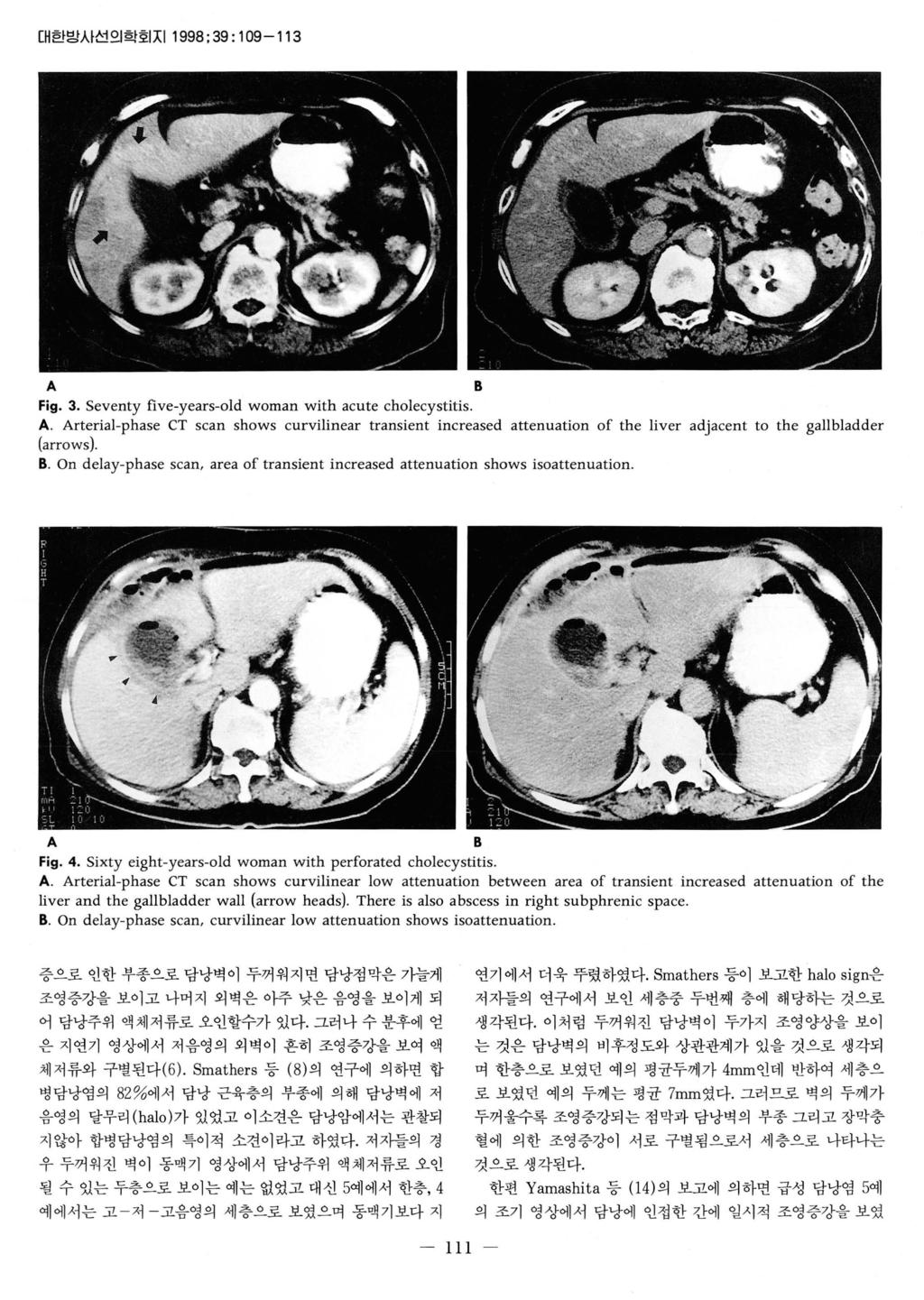 대한밤시선의학호 IXI1998;39 : 109-113 A B Fig. 3. Seventy five-years-old woman with acute cholecystitis. A. Arterial-phase CT scan shows curvilinear transient increased attenuation of the liver adjacent to the gallbladder (arrows) B.