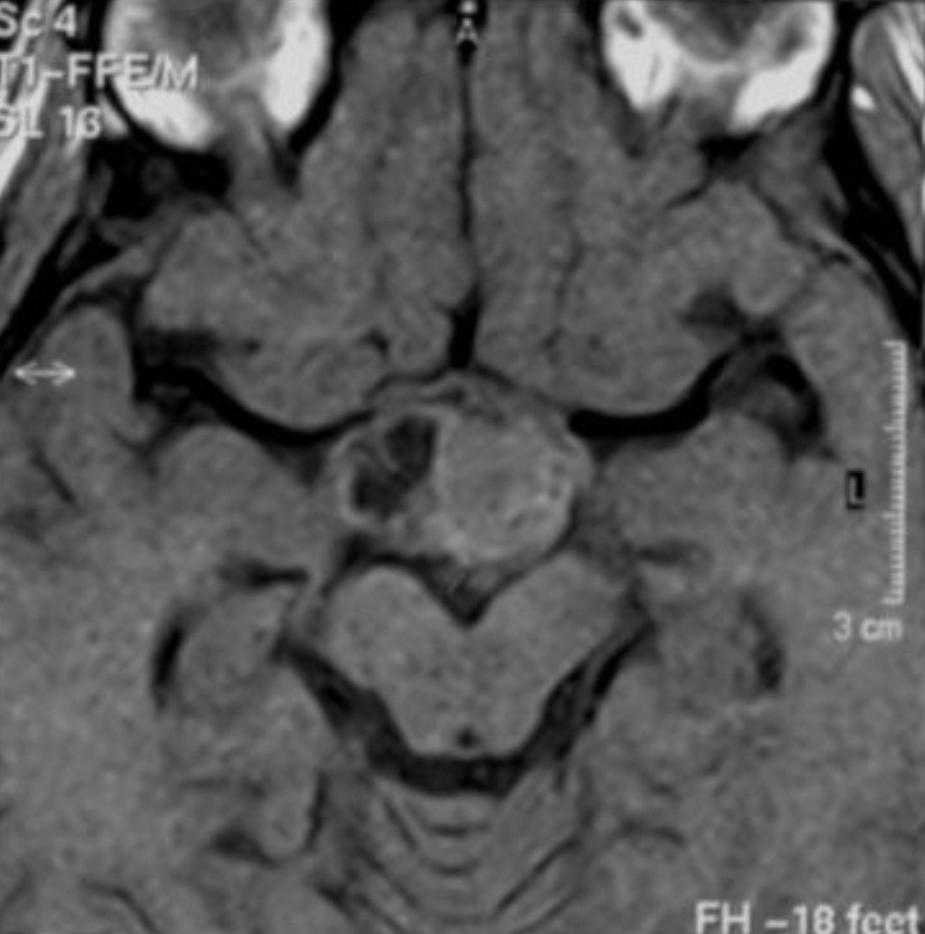7 16.8585 1.08 1.85 18.3 <1.0 0.30 36.7 18.6985 1.27 3.40 B Figure 1. Initial brain MRI showed a suprasellar mass containing a cystic portion (A).