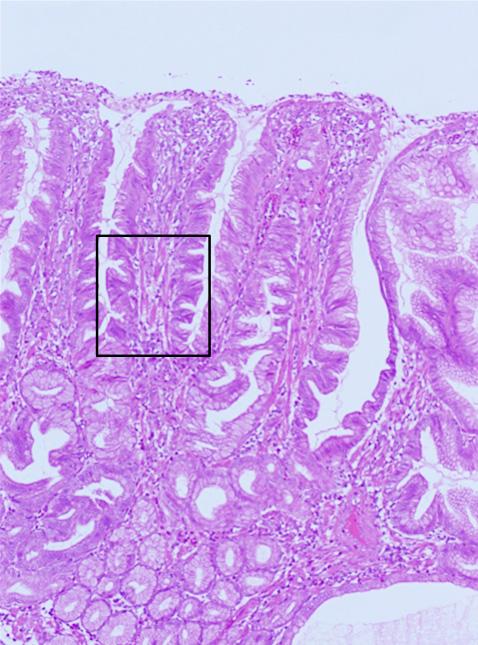 The focal proliferative dysplasic epithelium is shown in the box. Cells are stained with Hematoxylin & Eosin. 100 magnification. A B Figure 3. Gastric adenoma and hyperplastic polyps.