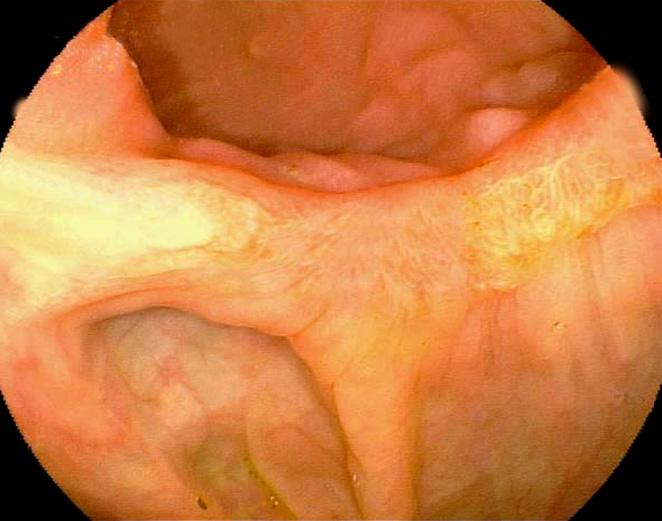 차재명 외: A Case of Crohn s Disease with an Initial Presentation of Granulomatous Appendicitis 었으며(Fig. 3), 충수돌기 주위로 농양과 섬유화가 관찰 되었다.