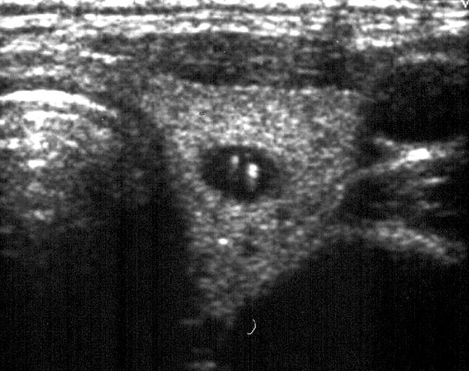 Fig. 5. Mixed echoic nodule. US shows mass containing both cystic and solid portion, called mixed echoic mass.