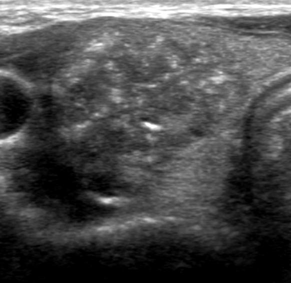 US shows hypoechoic nodule with taller than wide shape (anterior posterior dimension is greater than transverse dimension). 초음파에서발견한갑상선결절의진단을위해 US-FNAB 가시행된다.