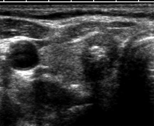 US shows numerous microcalcifications within the thyroid mass. Fig. 9. Malignant thyroid mass containing benign looking dense calcification.