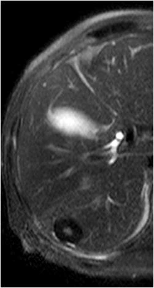 조기위암환자에서전이암과감별이필요했던간내단발성괴사성결절 d e f Fig. 1. A 77-year-old male with a solitary necrotic nodule in subcapsular portion of segment VI of liver, showing target appearance. d. T2-weighted 3T MRI shows a well-defined, hypointense nodule with smaller central hyperintense area.