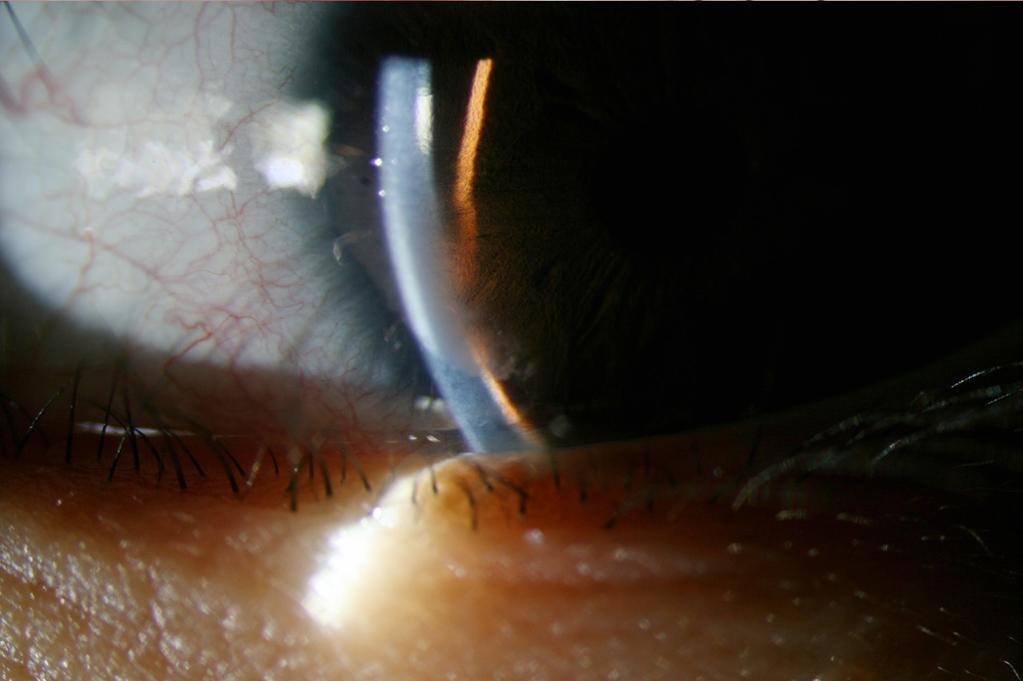Pupil is dragged inferonasally and band keratopathy is observed ().