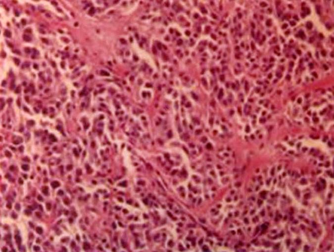 으로 paraganglioma와 감별이 필요한데 이는, 상피성 표지 으로 이러한 세포 배열 때문에, paraganglioma로 오진될 수 자에 염색되는 것으로 구별이 된다. 또한 atypical carcinoid 있다. 또한 세포질은 calcitonin에 강하게 염색되므로 갑상 는 편평세포암종과도 감별을 해야 한다.