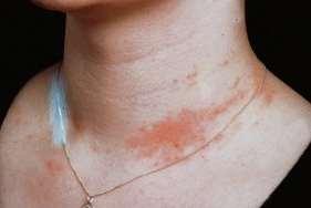 제 3 부토양오염 Source: http://fashionscapes.blogspot.kr Nickel: the most common source of skin allergies 3.