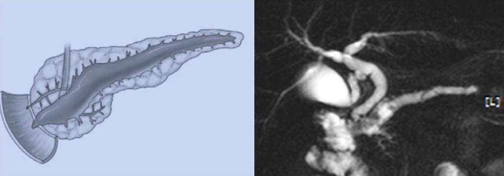 side) and MRI images (right side). (A) Branch duct IPMN.