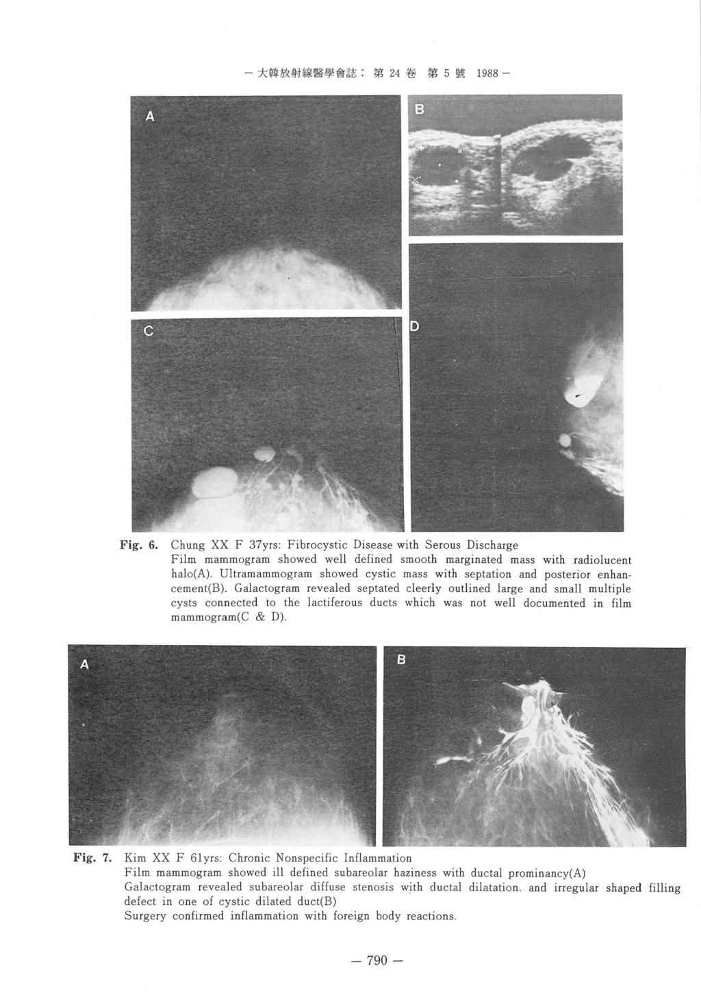 - 大짧放射線醫學會註. 第 卷第 號 1988 Fíg. 6. Chung XX F 37yrs: Fibrocystic Disease with Serous Discharge Film mammogram showed well defined smooth marginated mass with radiolucent halo(a).