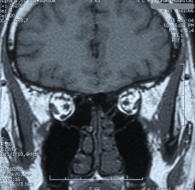 - 이은정외 12 인 : 일측성신무형성증과당뇨병을동반한칼만증후군 1 예 - Fig. 5. Sellar MRI shows bilateral absence of both olfactory bulb and olfactory sulci.