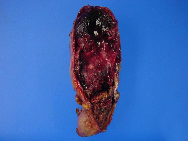 The adjacent hepatic ducts are dilated and have impacted black pigment stones.