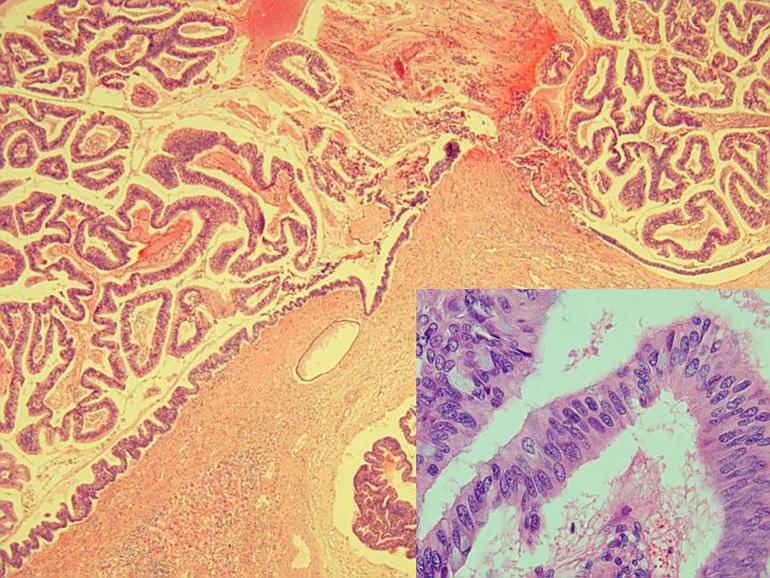 (B) The tumor cells of the gallbladder are diffusely arranged and focally syncytial large and pleomorphic