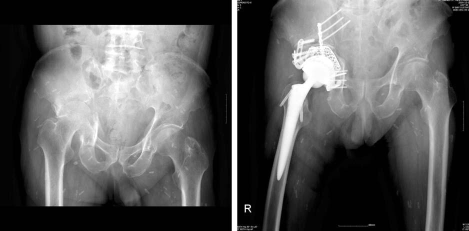 J Korean Hip Soc 22(2): 116-121, 2010 1) Judet and Letournel classification Elementary fracture Posterior wall Posterior column Anterior wall Anterior column Transverse Associated fracture: at least