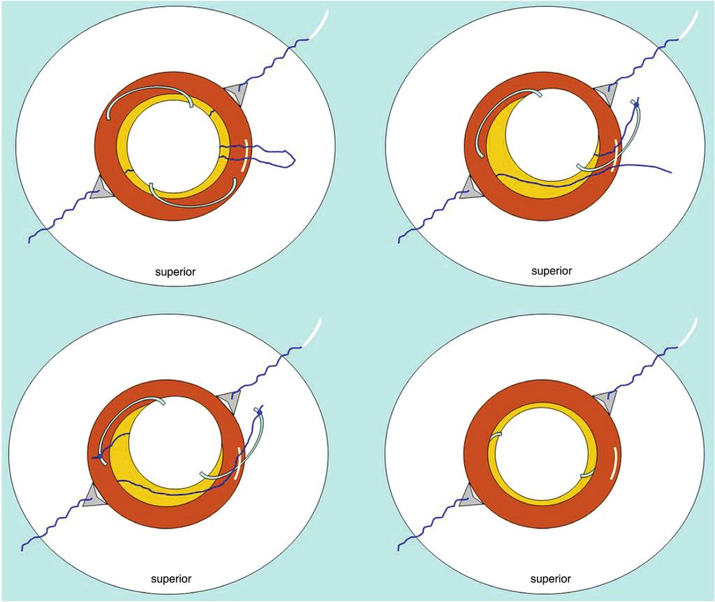 - 대한안과학회지 2009 년제 50 권제 7 호 - A B C D Figure 1. (A) The PC IOL is placed in the anterior chamber through the pupil and over the iris.