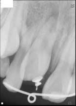 Fig. 12. Periapical view : 2 months after orthodontic traction. Fig. 13. Periapical view : 3 months after orthodontic traction. Fig. 14.