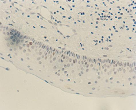 A B C D E F Fig. 1. A: Microscopic View of OKC(VEGF, 200). B: Microscopic View of Ameloblastoma(VEGF, 200).